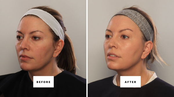a woman in her 40s before and after 8 treatments to lift her eyelids without a blepharoplasty